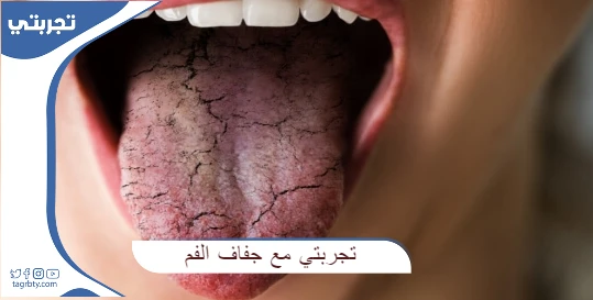 تجربتي مع جفاف الفم