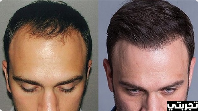 تجربتي مع زراعة الشعر باستخدام تقنية دي إتش آي
