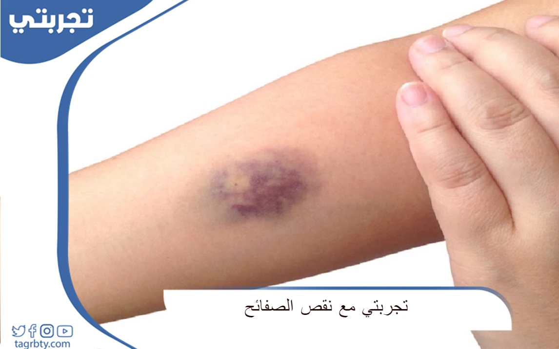 تجربتي مع نقص الصفائح الدموية