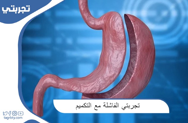 تجربتي الفاشلة مع التكميم