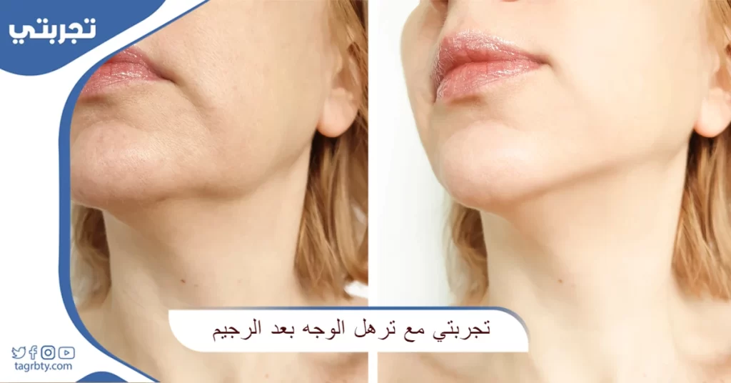 تجربتي مع ترهل الوجه بعد الرجيم