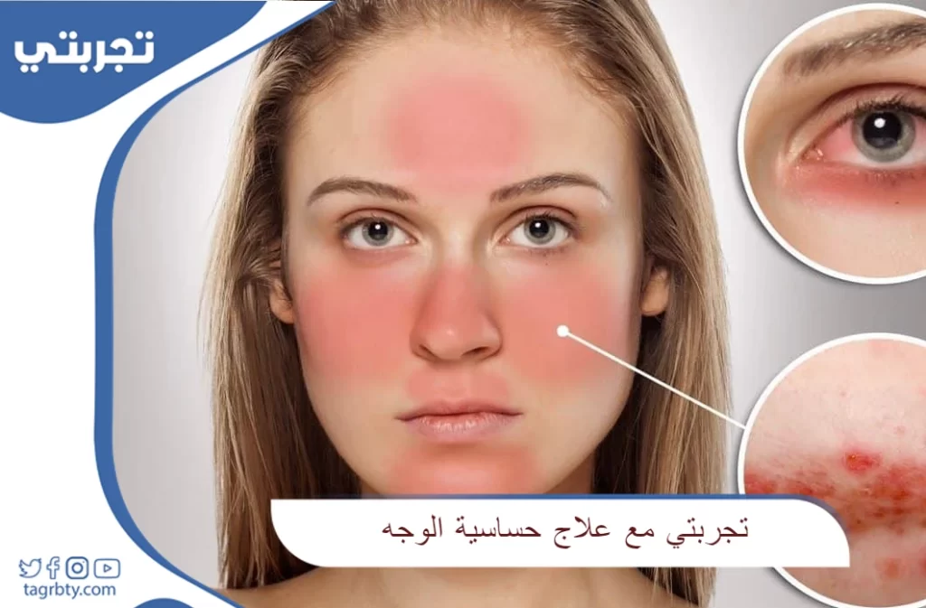 تجربتي مع علاج حساسية الوجه